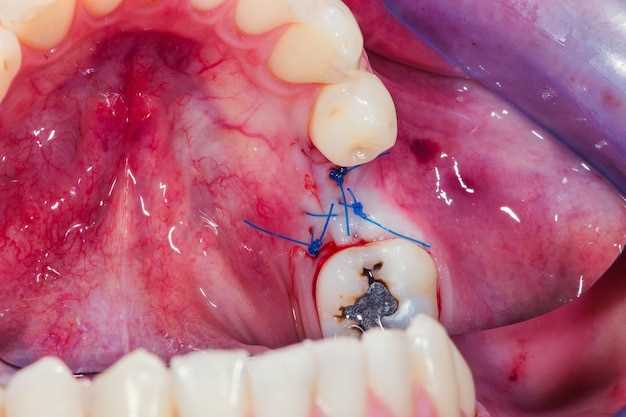 Лечение кисты зуба на десне